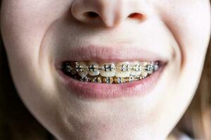 front view of dental braces on teeth of teenager photo