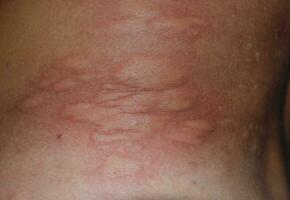 Allergy skin back and sides. Allergic reactions on the skin in the form of swelling and redness photo