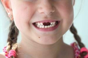 Close-up smile of a girl. A beautiful little girl 6-7 years old has lost milk teeth. Loss of milk teeth, replacement of permanent teeth. photo