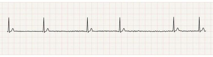 EKG Monitor Showing Atrial Fibrillation With Slow Ventricular Response vector