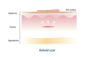 Keloid scar on skin surface vector illustration isolated on white background. Cross section of keloid scar spread beyond the borders of the initial injury, showing overgrowth of scar margin.