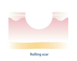 Cross section of rolling scar vector illustration isolated on white background. Rolling scar, atrophic scar, type of acne scar on skin surface. Skin care and beauty concept.