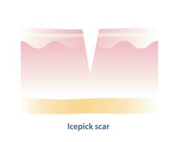 Cross section of icepick scar vector illustration isolated on white background. Icepick scar, atrophic scar, type of acne scar on skin surface. Skin care and beauty concept.