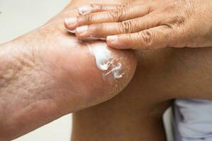 Woman care feet with cracked and dry heel skin cream at home. photo