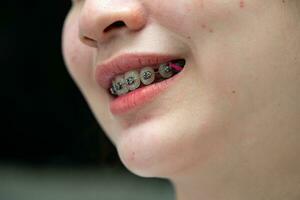 aparatos ortopédicos en la boca de una adolescente para tratar y embellecer para aumentar la confianza y la buena personalidad. foto