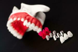 Teeth implant and crown installation process parts isolated on a black background. Medically accurate 3D model. photo