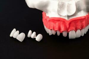 Teeth implant and crown installation process parts isolated on a black background. Medically accurate 3D model. photo