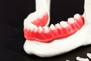 Teeth implant and crown installation process parts isolated on a black background. Medically accurate 3D model. photo