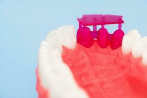 dientes implante y corona instalación proceso partes aislado en un azul antecedentes. médicamente preciso 3d modelo. foto