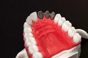 Teeth implant and crown installation process parts isolated on a blue background. Medically accurate 3D model. photo