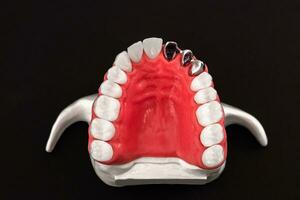 Teeth implant and crown installation process parts isolated on a blue background. Medically accurate 3D model. photo