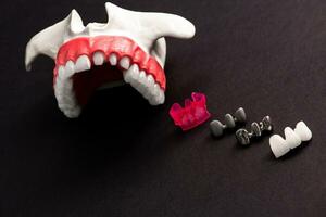 Teeth implant and crown installation process parts isolated on a black background. Medically accurate 3D model. photo