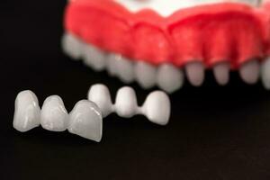 Teeth implant and crown installation process parts isolated on a black background. Medically accurate 3D model. photo