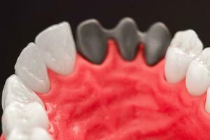 Teeth implant and crown installation process parts isolated on a blue background. Medically accurate 3D model. photo