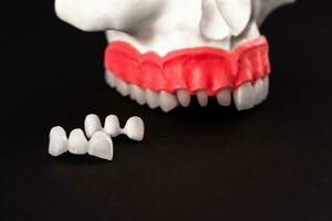 dientes implante y corona instalación proceso partes aislado en un negro antecedentes. médicamente preciso 3d modelo. foto