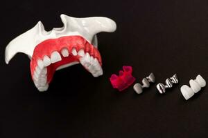 Teeth implant and crown installation process parts isolated on a black background. Medically accurate 3D model. photo