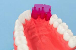 Teeth implant and crown installation process parts isolated on a blue background. Medically accurate 3D model. photo