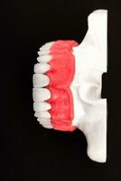 Teeth implant and crown installation process parts isolated on a blue background. Medically accurate 3D model. photo