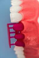 dientes implante y corona instalación proceso partes aislado en un azul antecedentes. médicamente preciso 3d modelo. foto