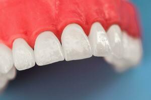 Teeth implant and crown installation process parts isolated on a blue background. Medically accurate 3D model. photo