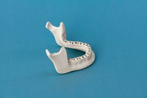 Upper human jaw without teeth model medical implant isolated on blue background. Healthy teeth, dental care and orthodontic concept. photo