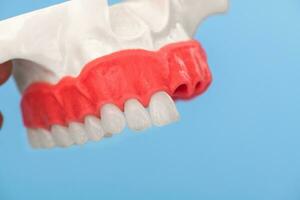 Teeth implant and crown installation process parts isolated on a blue background. Medically accurate 3D model. photo