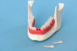 Teeth implant and crown installation process parts isolated on a blue background. Medically accurate 3D model. photo