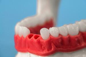 Teeth implant and crown installation process parts isolated on a blue background. Medically accurate 3D model. photo