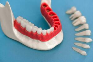 dientes implante y corona instalación proceso partes aislado en un azul antecedentes. médicamente preciso 3d modelo. foto