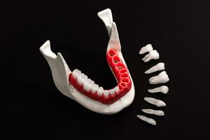 Teeth implant and crown installation process parts isolated on a black background. Medically accurate 3D model. photo