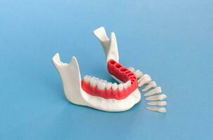 Teeth implant and crown installation process parts isolated on a blue background. Medically accurate 3D model. photo