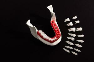 Teeth implant and crown installation process parts isolated on a black background. Medically accurate 3D model. photo