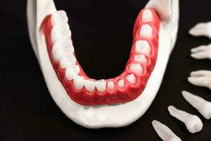 Teeth implant and crown installation process parts isolated on a black background. Medically accurate 3D model. photo