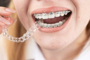 Dental care.Smiling girl with braces on her teeth holds aligners in her hands and shows the difference between them photo