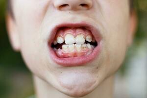 boca abierta de un niño con placa o cálculo en los dientes cerrados. concepto de higiene bucal foto