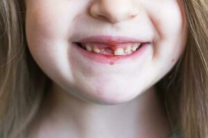 A little cute girl lost her front baby milk tooth. Lost temporary tooth. photo