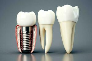 Close up of a dental tooth implant or healthy human teeth. White enamel and dental implants surgery concept by AI Generated photo