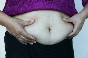 Closeup woman hands touch big belly, fat with cellulite abdomen. Concept, obesity. Overweight. Body shape problem for woman after pregnancy or getting older. Heath care. photo