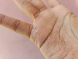 calluses hands. peeling and wrinkled photo