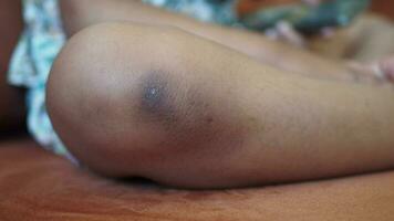 stain bruise wound on child knee video