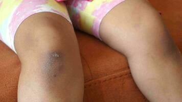 stain bruise wound on child knee. video