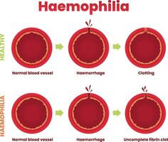 ilustración de hemofilia, sano sangre buque vs hemofilia infografía vector