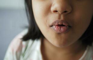 cerca arriba de seco labio de un niño foto