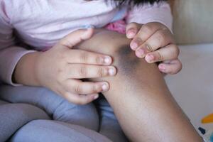 stain bruise wound on child knee. photo