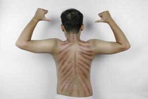 Red marks from scrapes coin on a man's back. Kerokan is a way of traditional Javanese culture medical treatment to treat symptoms of colds in Indonesia photo