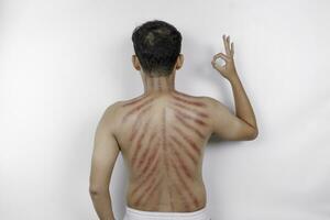 Red marks from scrapes coin on a man's back. Kerokan is a way of traditional Javanese culture medical treatment to treat symptoms of colds in Indonesia photo