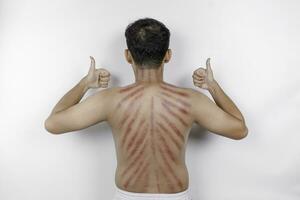 Red marks from scrapes coin on a man's back. Kerokan is a way of traditional Javanese culture medical treatment to treat symptoms of colds in Indonesia photo