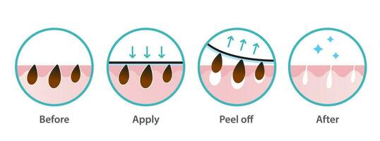 Blackhead removal process vector icon set illustration on white background. Cross section of  blackhead pore strip treatment, apply, peel off, unclogging and tighten pores. Before and after concept.