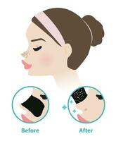 Before and after blackhead pore strip treatment vector illustration isolated on white background. Diagram of woman face with blackhead pore strip on nose, icon set of  how to use removal pore strip.