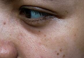 negro lugares, lunares y cicatrices en el cara de asiático mujer. foto